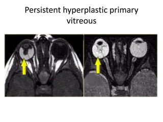 Persistent hyperplastic primary
vitreous
 