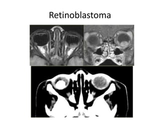 Retinoblastoma
 