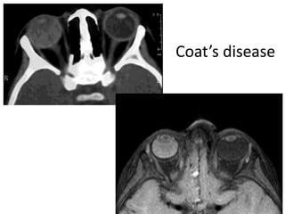 Coat’s disease
 