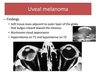 Uveal melanoma
– Findings
• Soft tissue mass adjacent to outer layer of the globe
that bulges inward toward the vitreous
• Mushroom cloud appearance
• Hyperintense on T1 and hypointense on T2
 
