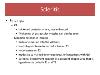 • Findings:
– CT:
• thickened posterior sclera, may enhanced
• Thickening of extraocular muscles can also be seen
– Magnetic resonance imaging
• nodular elevation into the vitreous
• Iso-to-hyperintense to normal sclera on T1
• Hypointense on T2
• moderate to marked inhomogeneous enhancement with Gd
• A retinal detachment appears as a crescent-shaped area that is
hyperintense on both T1 and T2
Scleritis
 
