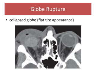 • collapsed globe (flat tire appearance)
Globe Rupture
 