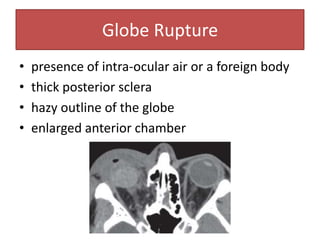 • presence of intra-ocular air or a foreign body
• thick posterior sclera
• hazy outline of the globe
• enlarged anterior chamber
Globe Rupture
 