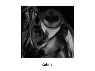 Retinal
 