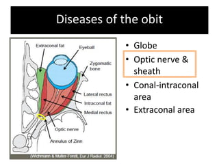 Diseases of the obit
• Globe
• Optic nerve &
sheath
• Conal-intraconal
area
• Extraconal area
 