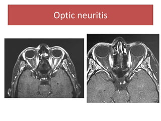 Optic neuritis
 