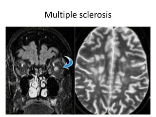 Multiple sclerosis
 