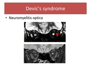 Devic's syndrome
• Neuromyelitis optica
 