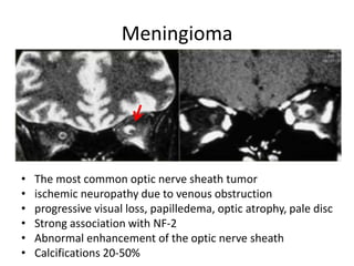Meningioma
• The most common optic nerve sheath tumor
• ischemic neuropathy due to venous obstruction
• progressive visual loss, papilledema, optic atrophy, pale disc
• Strong association with NF-2
• Abnormal enhancement of the optic nerve sheath
• Calcifications 20-50%
 