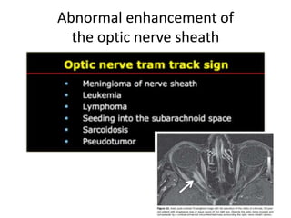 Abnormal enhancement of
the optic nerve sheath
 