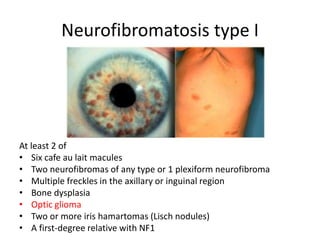Neurofibromatosis type I
At least 2 of
• Six cafe au lait macules
• Two neurofibromas of any type or 1 plexiform neurofibroma
• Multiple freckles in the axillary or inguinal region
• Bone dysplasia
• Optic glioma
• Two or more iris hamartomas (Lisch nodules)
• A first-degree relative with NF1
 