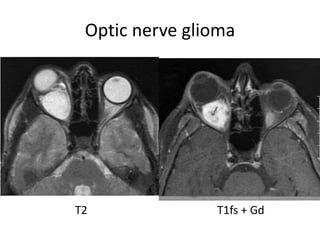 Optic nerve glioma
T2 T1fs + Gd
 