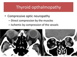 Thyroid opthalmopathy
• Compressive optic neuropathy
– Direct compression by the muscles
– Ischemic by compression of the vessels
 