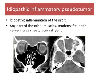 Idiopathic inflammatory pseudotumor
• Idiopathic inflammation of the orbit
• Any part of the orbit: muscles, tendons, fat, optic
nerve, nerve sheet, lacrimal gland
 