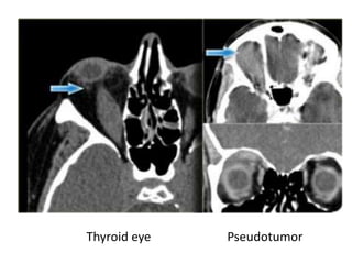 Thyroid eye Pseudotumor
 