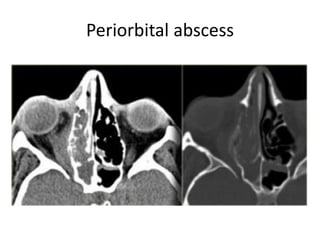 Periorbital abscess
 