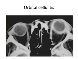 Orbital cellulitis
 