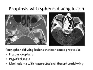 Proptosis with sphenoid wing lesion
Four sphenoid wing lesions that can cause proptosis:
• Fibrous dysplasia
• Paget's disease
• Meningioma with hyperostosis of the sphenoid wing
 