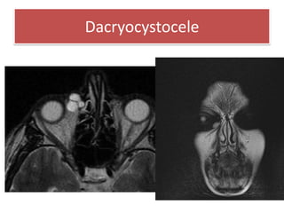 Dacryocystocele
 