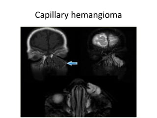 Capillary hemangioma
 