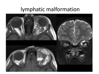lymphatic malformation
 