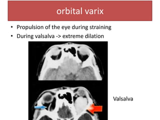 orbital varix
• Propulsion of the eye during straining
• During valsalva -> extreme dilation
Valsalva
 
