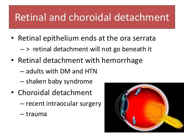 49 Retinal And Choroidal Detachment 49 Retinal And Choroidal Detachment