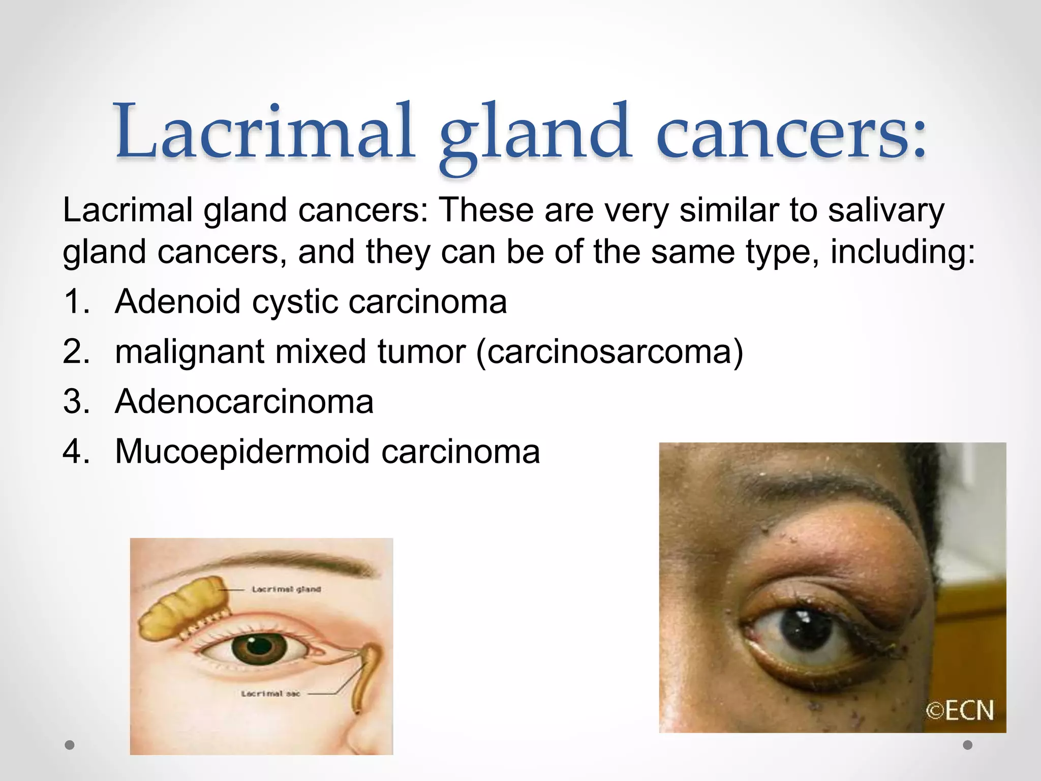 Lacrimal gland cancers:
Lacrimal gland cancers: These are very similar to salivary
gland cancers, and they can be of the same type, including:
1. Adenoid cystic carcinoma
2. malignant mixed tumor (carcinosarcoma)
3. Adenocarcinoma
4. Mucoepidermoid carcinoma
 