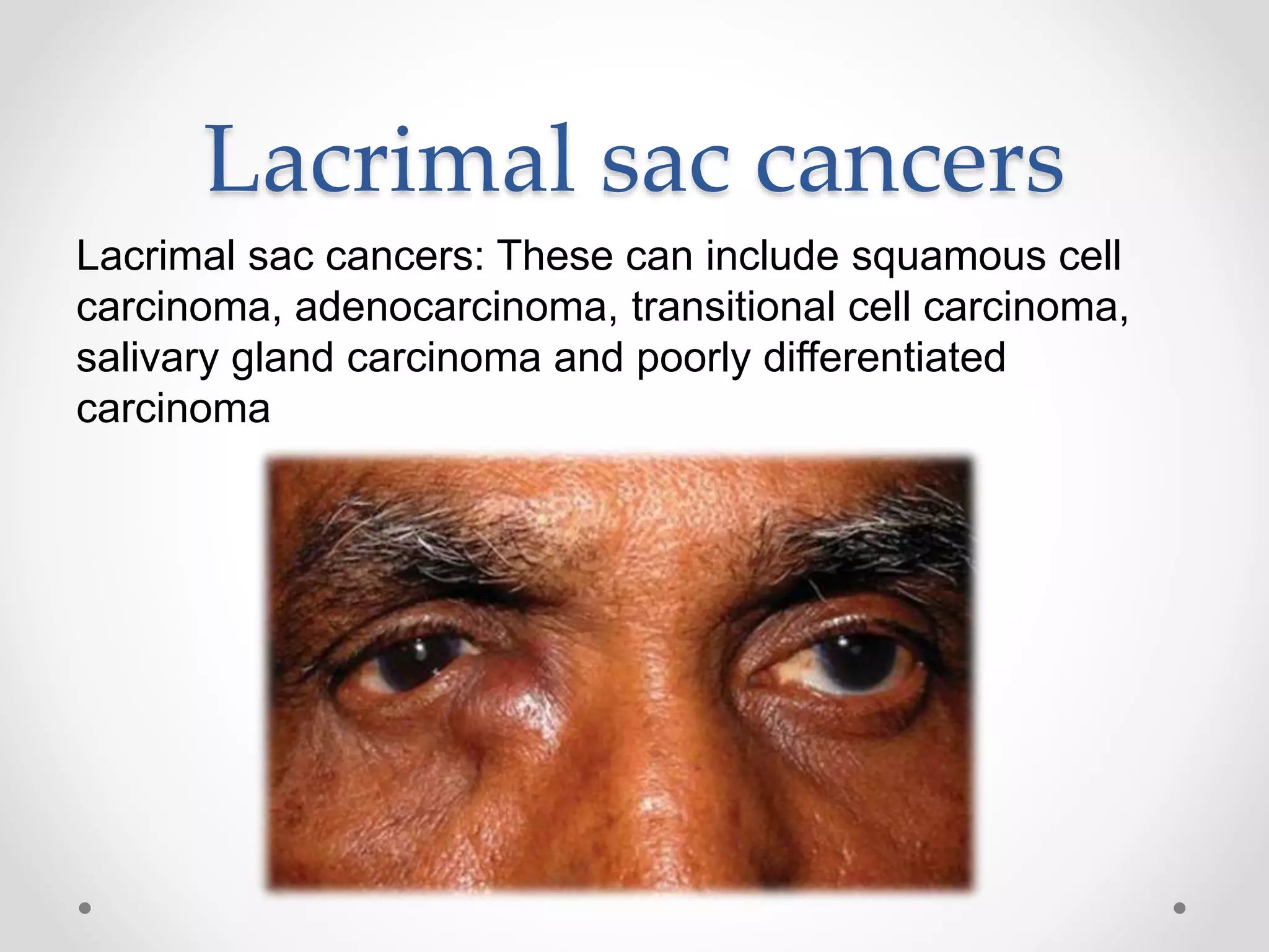 Lacrimal sac cancers
Lacrimal sac cancers: These can include squamous cell
carcinoma, adenocarcinoma, transitional cell carcinoma,
salivary gland carcinoma and poorly differentiated
carcinoma
 