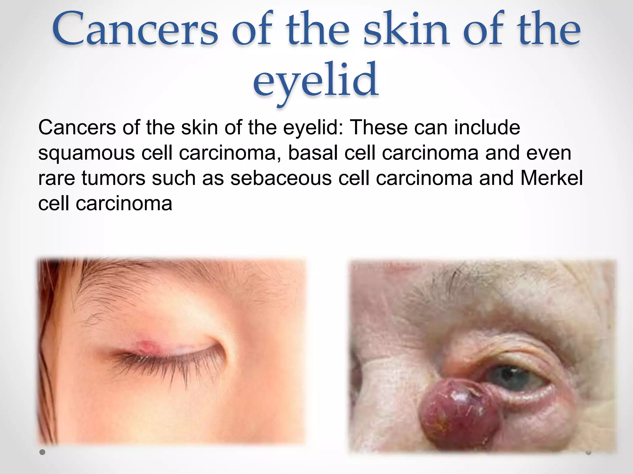 Cancers of the skin of the
eyelid
Cancers of the skin of the eyelid: These can include
squamous cell carcinoma, basal cell carcinoma and even
rare tumors such as sebaceous cell carcinoma and Merkel
cell carcinoma
 