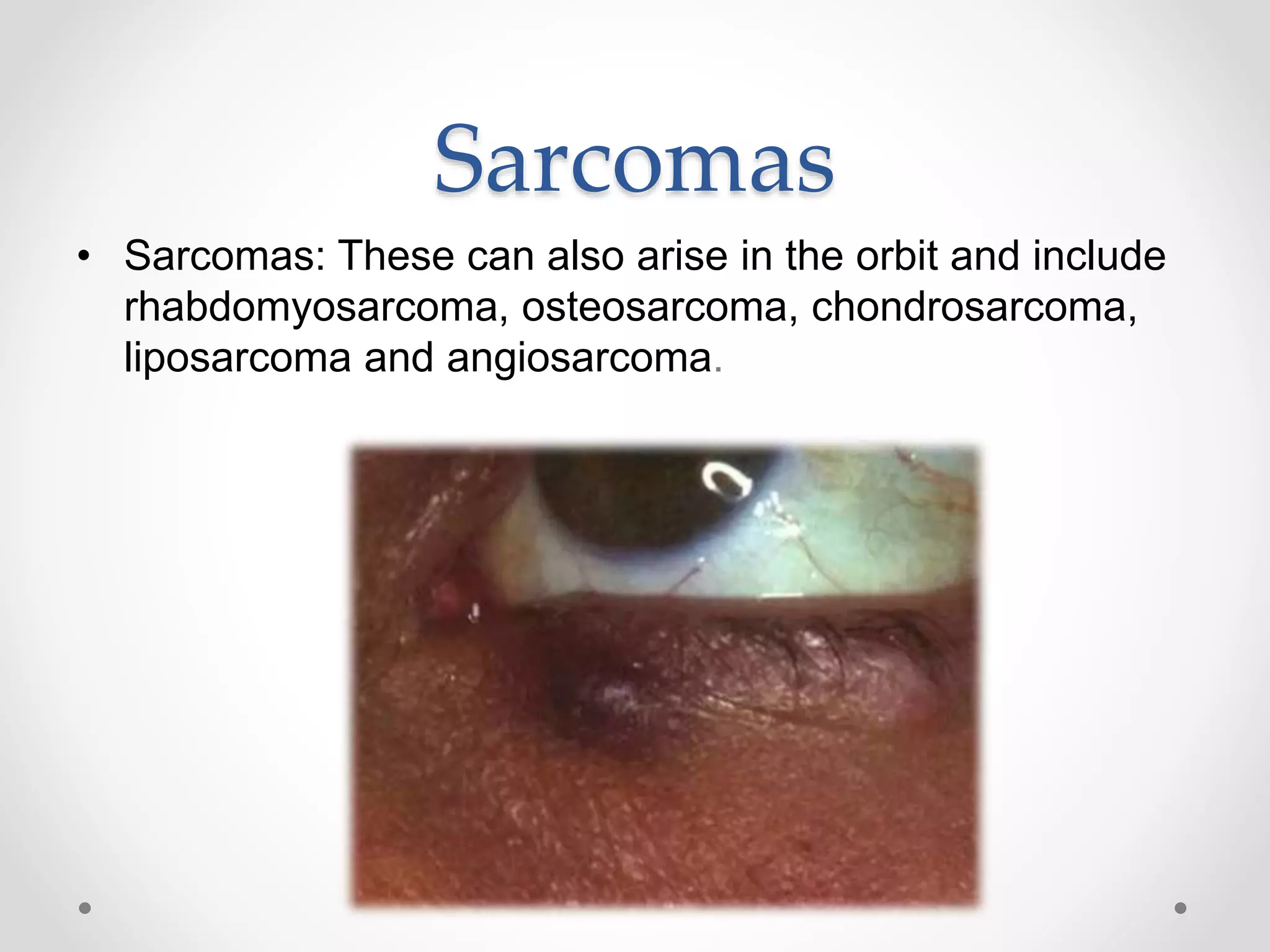 Sarcomas
• Sarcomas: These can also arise in the orbit and include
rhabdomyosarcoma, osteosarcoma, chondrosarcoma,
liposarcoma and angiosarcoma.
 