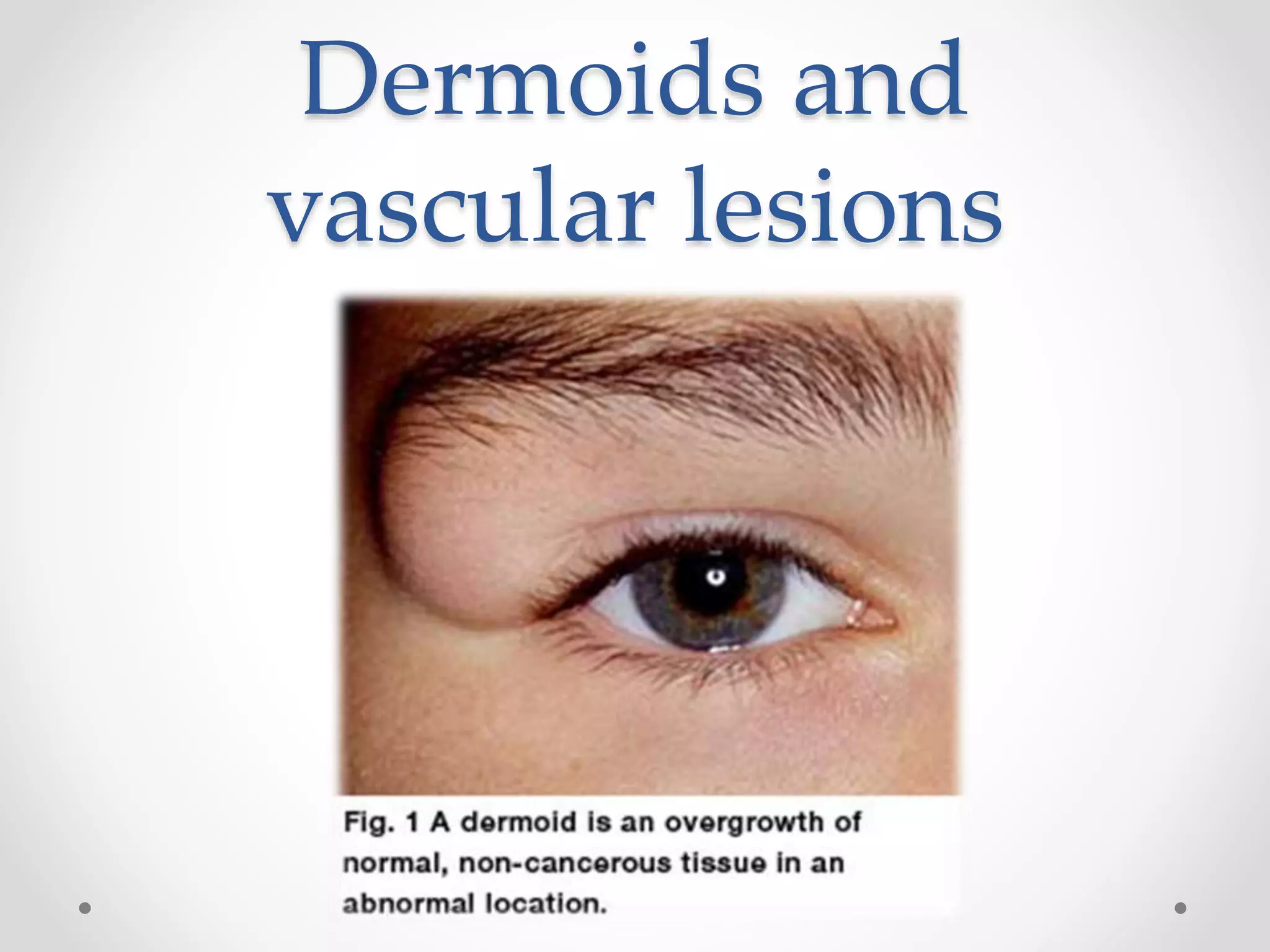 Dermoids and
vascular lesions
 