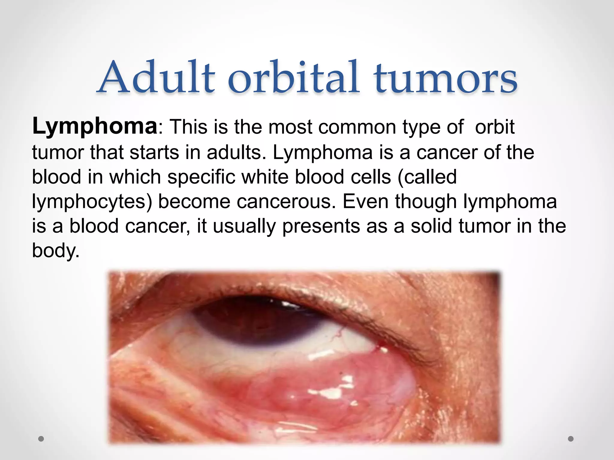 Adult orbital tumors
Lymphoma: This is the most common type of orbit
tumor that starts in adults. Lymphoma is a cancer of the
blood in which specific white blood cells (called
lymphocytes) become cancerous. Even though lymphoma
is a blood cancer, it usually presents as a solid tumor in the
body.
 