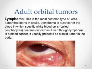 Orbital Tumour PPTX