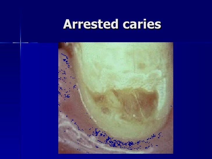 Theories of dental caries.ppt