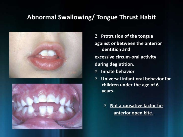 swallowing nabil abnormal thrusting protrusion zubair
