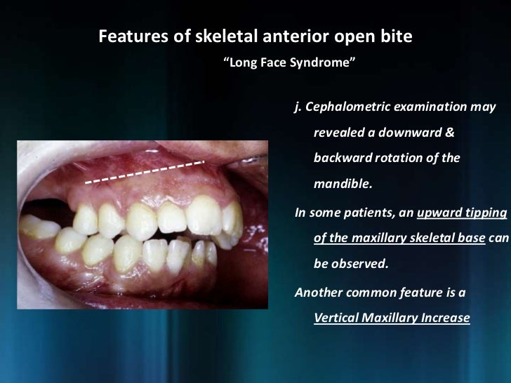 Management of Open Bite Dr. Nabil AlZubair