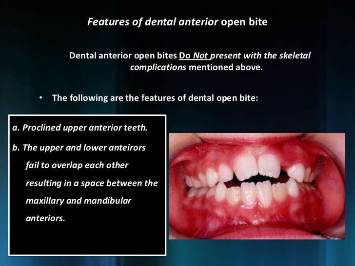 Management of Open Bite Dr. Nabil AlZubair