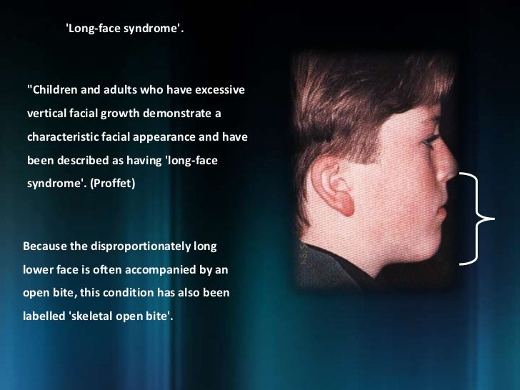 Long face syndrome pictures