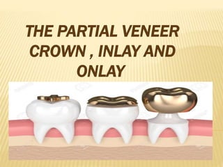 THE PARTIAL VENEER
CROWN , INLAY AND
ONLAY
 