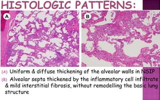 Nsip Classification The Pathology of Acute Lung Injury | PPTX