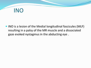 INO
 INO is a lesion of the Medial longitudinal fascicules (MLF)
resulting in a palsy of the MR muscle and a dissociated
gaze evoked nystagmus in the abducting eye .
 