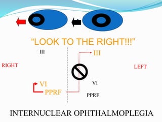 “LOOK TO THE RIGHT!!!”
III III
VI VI
PPRF PPRF
RIGHT LEFT
INTERNUCLEAR OPHTHALMOPLEGIA
 