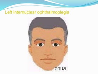 Left internuclear ophthalmoplegia
 