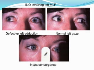 Defective left adduction Normal left gaze
Intact convergence
INO involving left MLF
 