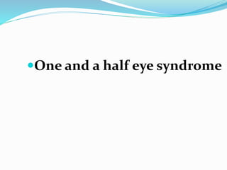 One and a half eye syndrome
 