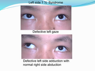 Defective left gaze
Defective left side adduction with
normal right side abduction
Left side 1 ½ Syndrome
 