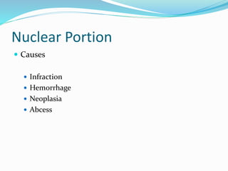 Nuclear Portion
 Causes
 Infraction
 Hemorrhage
 Neoplasia
 Abcess
 
