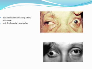  posterior communicating artery
aneurysm
 and third cranial nerve palsy
 