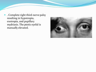  . Complete right third-nerve palsy
resulting in hypotropia,
exotropia, and pupillary
mydriasis. The ptotic eyelid is
manually elevated.
 